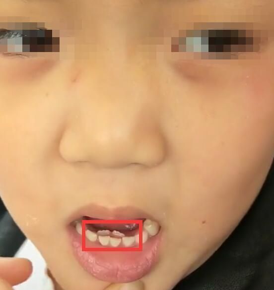 7岁男孩长了"双排牙",需要慢慢地拔掉后排牙,奶奶:都怪我