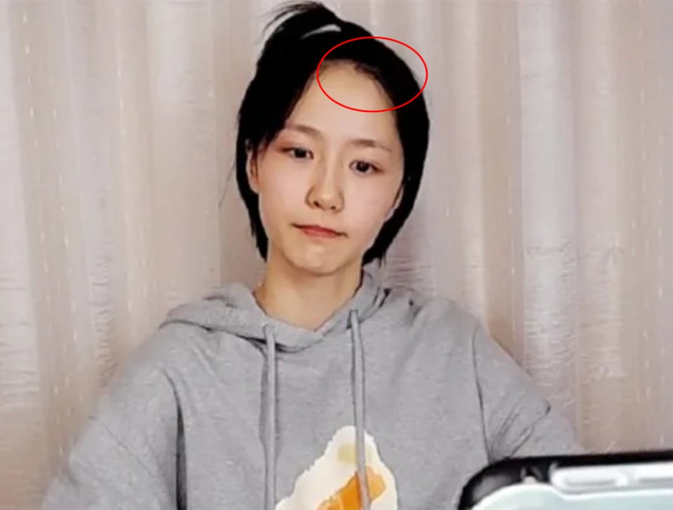 皮肤长痘发际线堪忧,宅男要脱粉