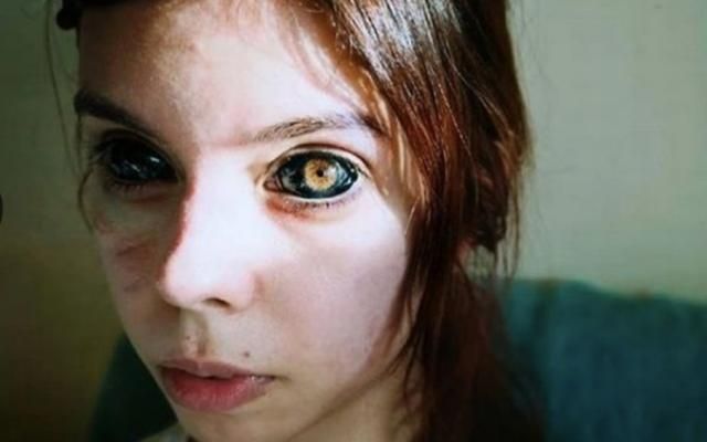 波兰25岁模特为追星把眼球染成黑色导致失明纹身师或将入狱