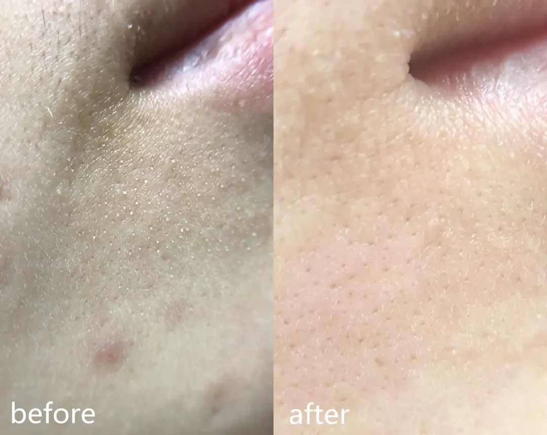 拿小绿瓶清下巴效果也特别好原来的疙疙瘩瘩全部没有了成分安全0痛感