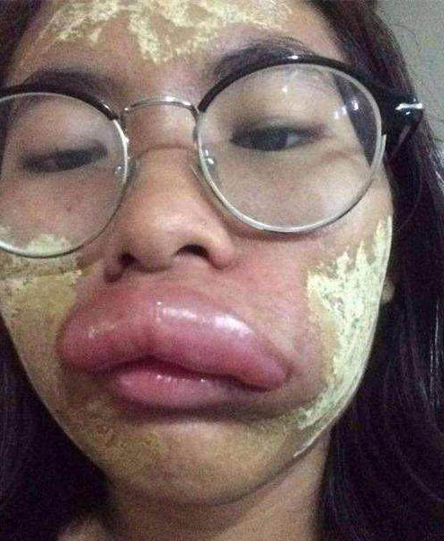 泰国一女子嘴巴肿成"香肠",得知原因后,医生不淡定