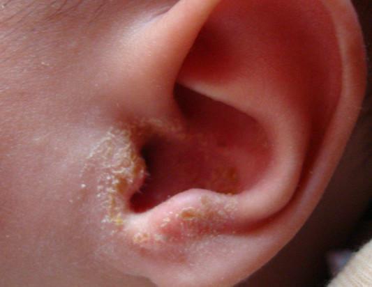 婴儿外耳廓流黄水结痂图片