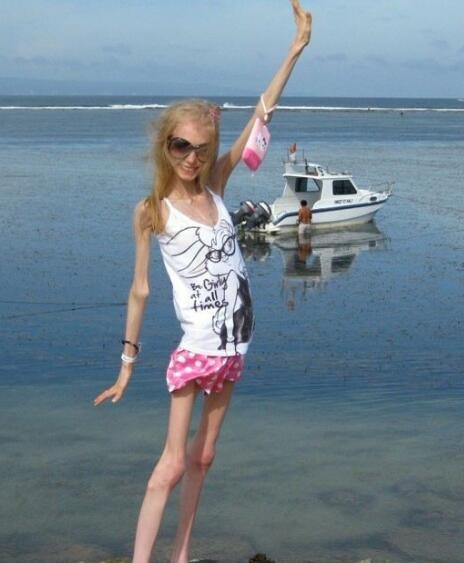 患上厌食症骨瘦如柴,看着就像一骷髅和鬼没两样,起因是它惹的祸