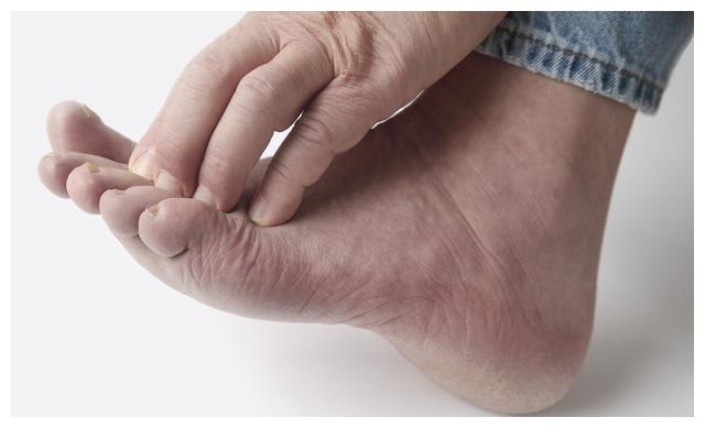 脚汗多的人,大致是这三种原因!