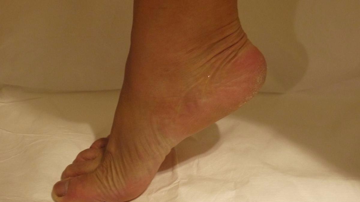 脚后跟开裂脱皮怎么办?每天用它抹一抹,3天变光滑,实用又简单