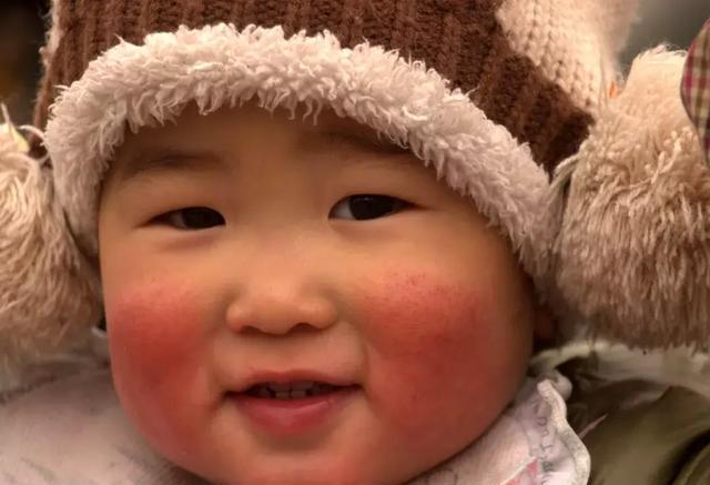 宝宝冬天红脸蛋不是可爱,可能暗示着这些症状!