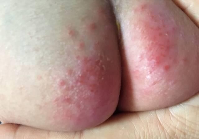 这样给宝宝使用尿不湿,容易造成宝宝泌尿系统感染,高烧不退