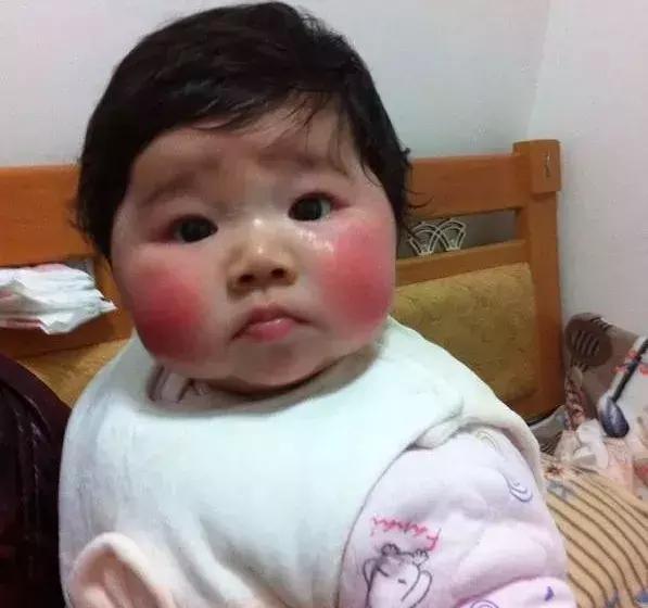 宝宝冬天红脸蛋不是可爱可能暗示着这些症状