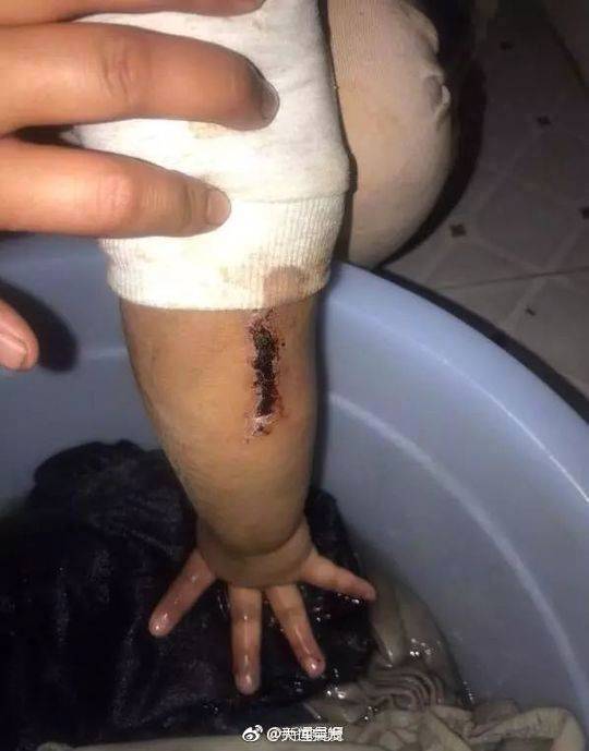 4岁女童疑遭亲父虐待遍体鳞伤!被栓在厕所里[怒]