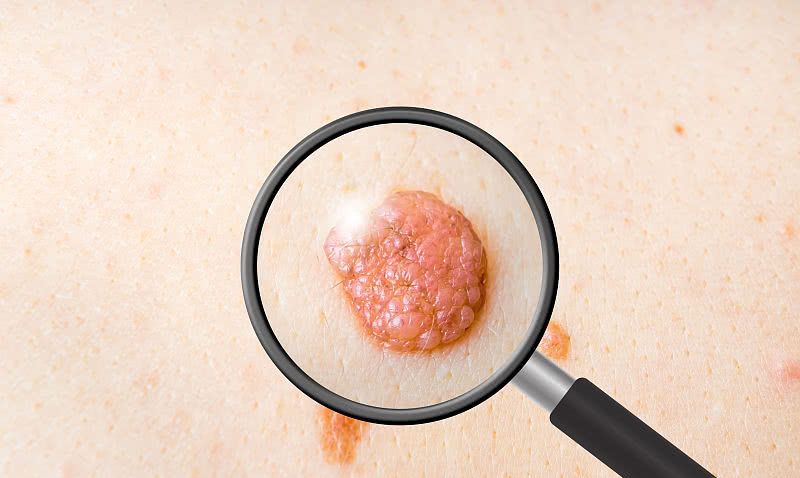 皮肤上长出这种痣的时候,十有八九是黑色素瘤,一定要及时切除!