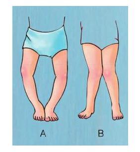 子出现xo型腿并不是正常的现象而是由于很多原因导致