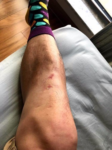 相比起国乒来说,国足名将王永珀在一场比赛中被对手擦伤了膝盖,就马上