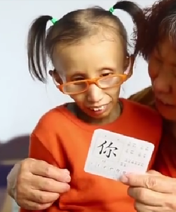 科凯恩综合征,俗称早衰症,发病率仅仅只有百万分之一,可这百万分之一