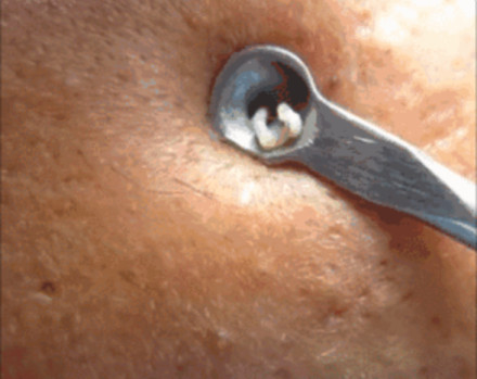 明知道很恶心,为什么你还爱看挤痘痘、挖耳屎