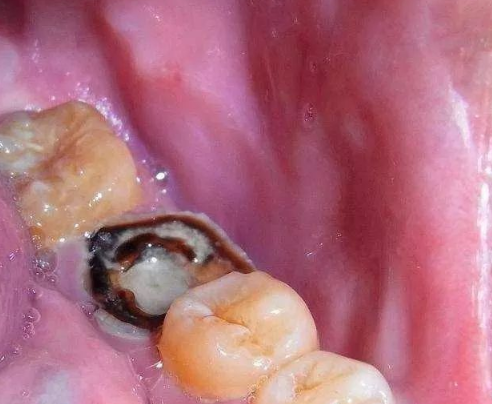 两岁孩子从不吃糖,却满口的蛀牙,去医院检查,医生大骂:无知