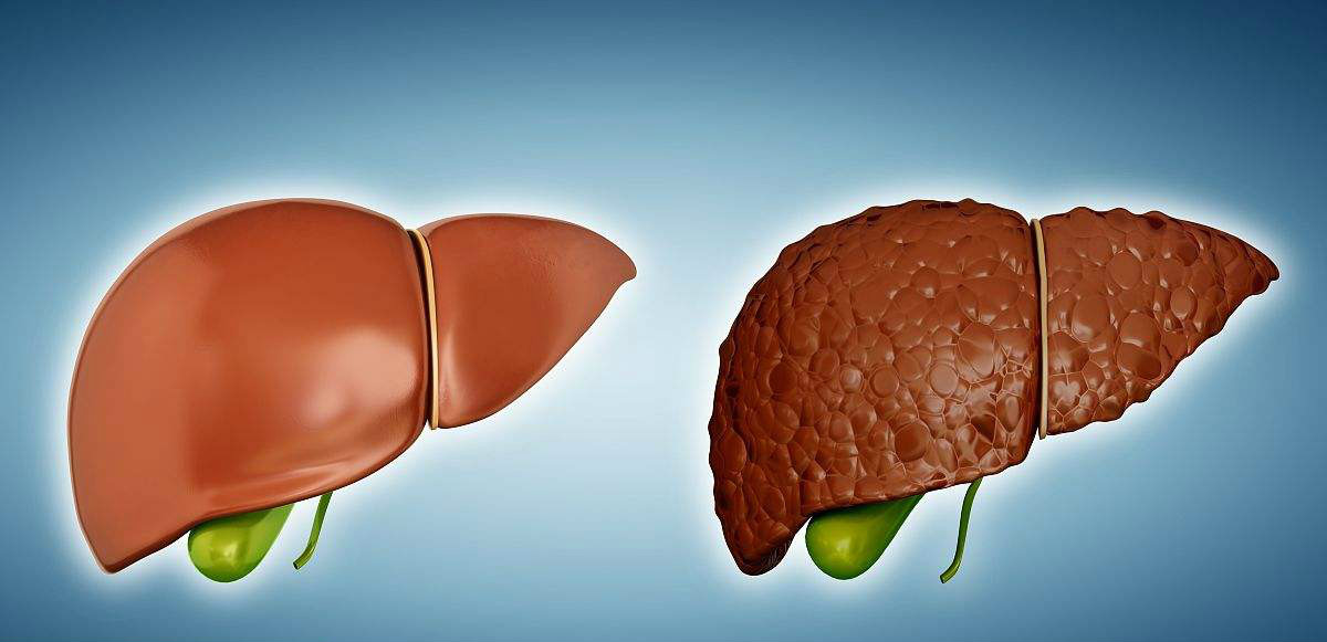 三种肝病要及时治疗,医生说四类人最好每年都体检一次