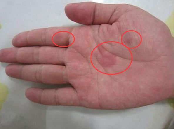 手掌|蜘蛛痣|水泡_新浪新闻