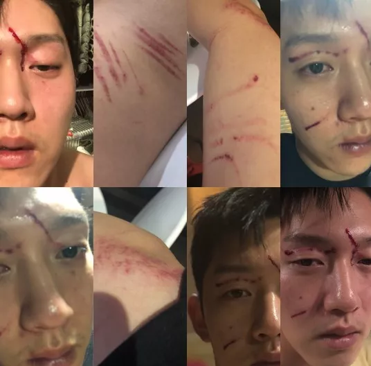 崔钟范公布的受伤照片里,他的成先亲ド;而具荷拉所公布的照片里