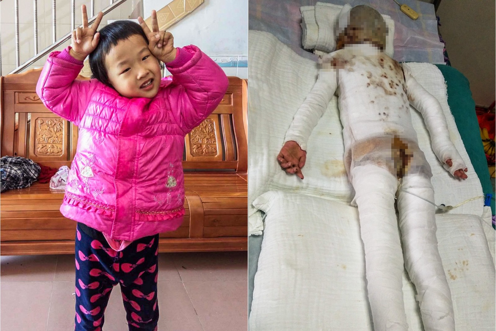 女孩被烧成"纱布人", 难忍剧痛曾偷偷拔管,康复要签"生死状"