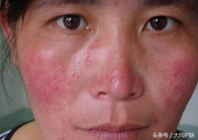 皮肤敏感泛红,角质层薄,毛孔粗大怎么办?|毛孔|肌肤|角质层_新浪新闻
