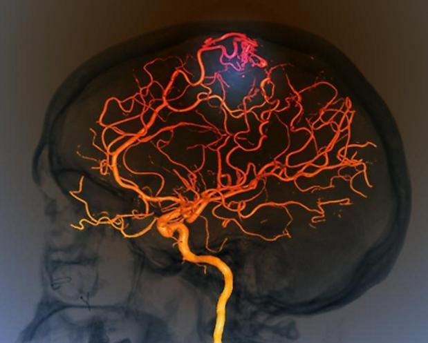 6个警报,提示脑血管又脏又堵,常喝1种水,冲净血管阻止来脑梗
