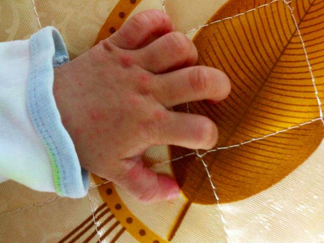 疱疹性咽峡炎算是病情较轻的一种,一般1-2周会自愈,而手足口病则会0