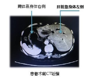 "镜面人"器官异位,心脏长在右边,治个胆结石难坏了医生