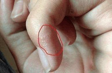 手掌|蜘蛛痣|水泡_新浪新闻