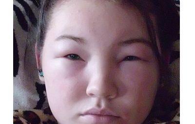 为什么会有水肿脸, 如何去除水肿呢?