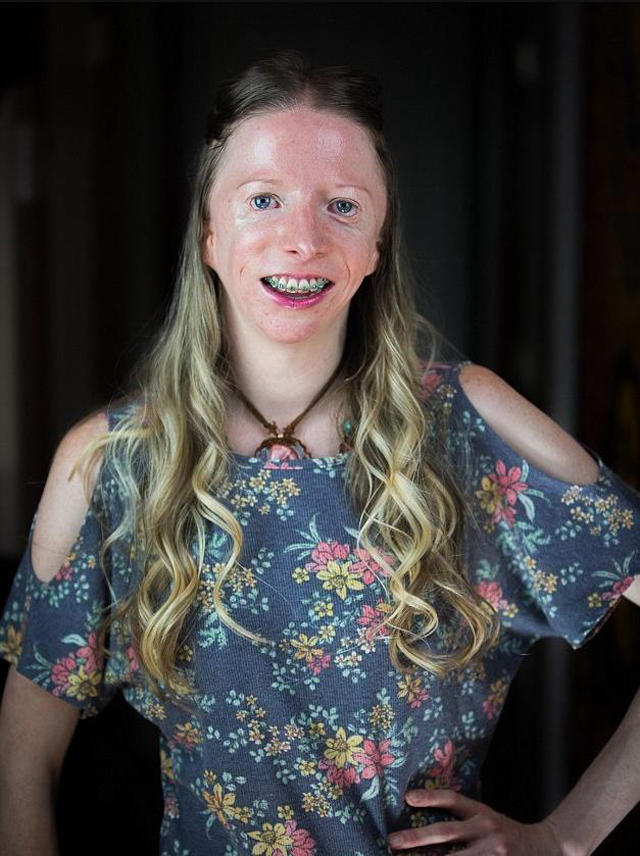 美国一女子患罕见疾病,面容和鱼脸一样,丈夫称是世界最美女人