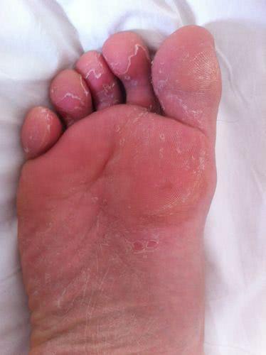 夏天脚气反复难受, 几块钱让你轻松告别脚气, 不再复发__财经头条