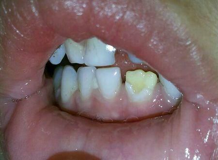 育儿辟谣系列七乳牙反正也要换坏了也没关系