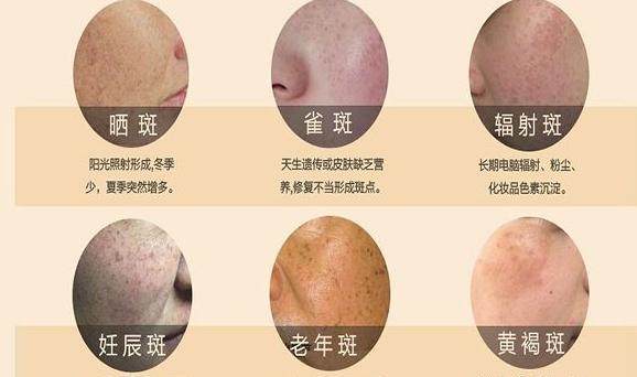 如何做不一"斑"的女人