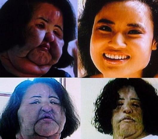 韩国女子整容失败变"丑八怪",如今的样子惨不忍睹!