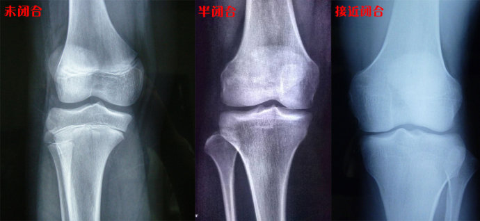 骨骺线闭合状态给幼小的孩子使用化妆品有哪些危害?1,导致性早熟.