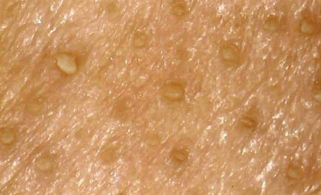 洗脸前,毛孔布满皮脂管丝