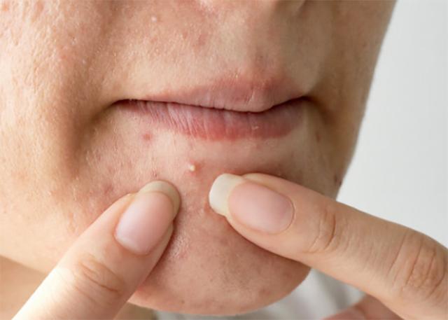 脸上长痘因为螨虫?3个信号别忽视,用1方法洗很快消除一大半!