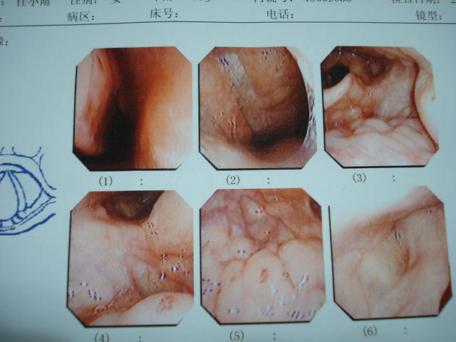 8个月宝宝喉咙肿误以为猪头风查明原因后只怪妈妈太粗心