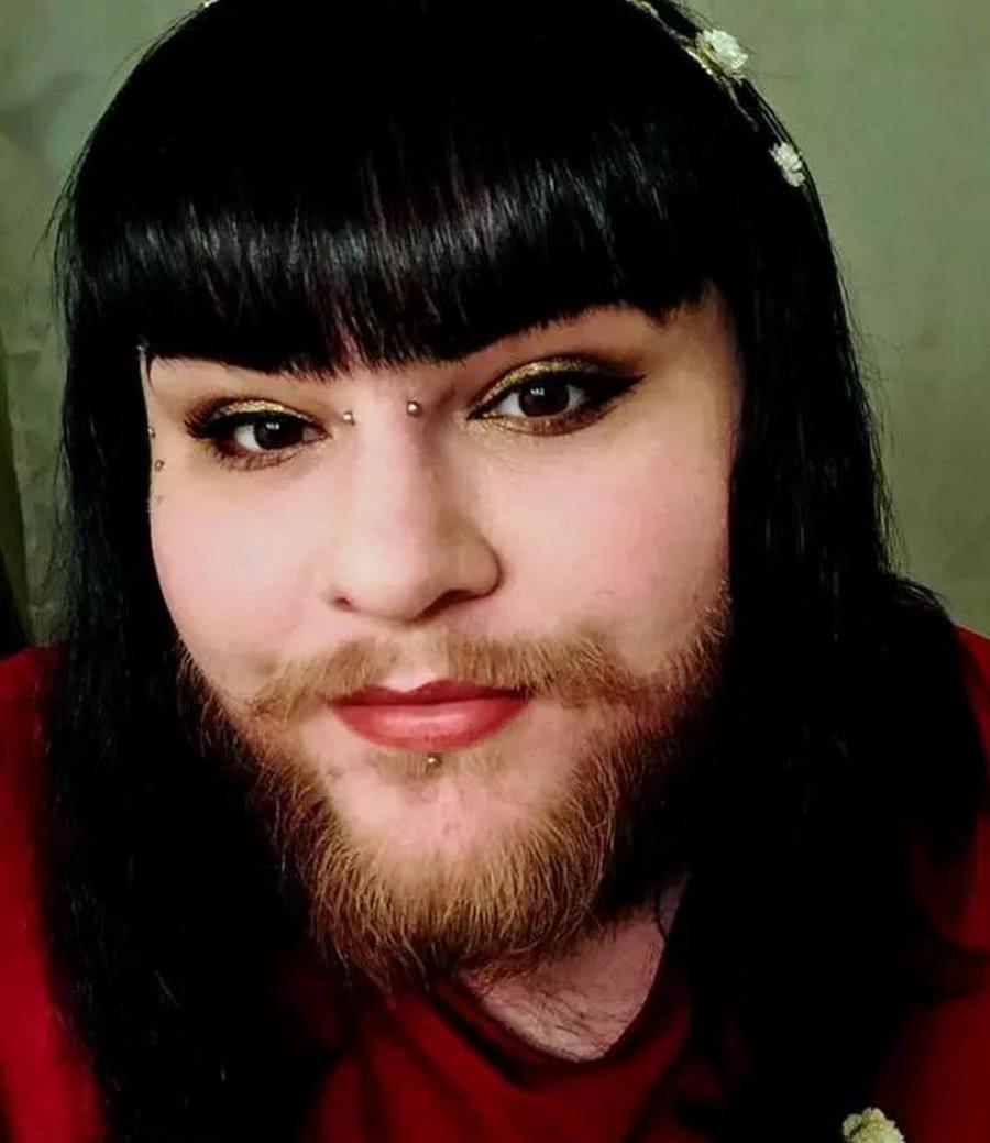 26岁女子体毛旺盛,满脸络腮胡,比男人的胡子还茂密