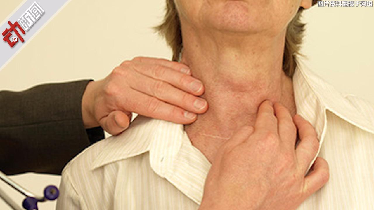 女子声带息肉如"韭菜" 5年4次手术仍生长 动画揭秘为何割不尽