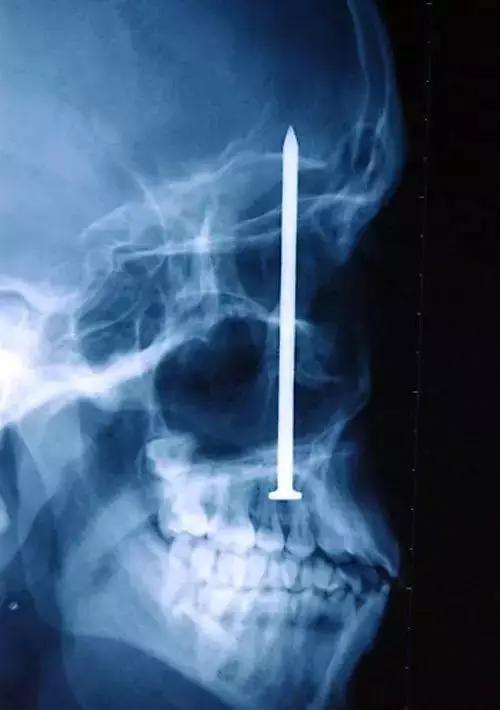 盘点x光透视下的人体异物,太惊悚了,看着都痛!__财经头条