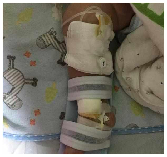 5个月宝宝得了败血症医好又复发,一半以上的生命都是在医院度过