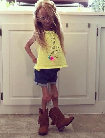 距离死亡只剩两年早衰女孩乐观外向百万粉求上天保佑她