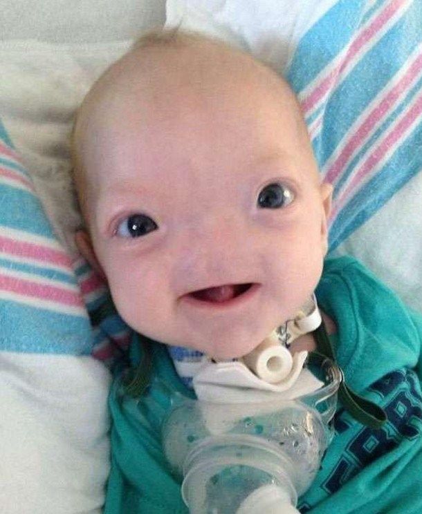 这个婴儿出生就没有鼻子,父母觉得非常个性,拒绝帮他补鼻子!