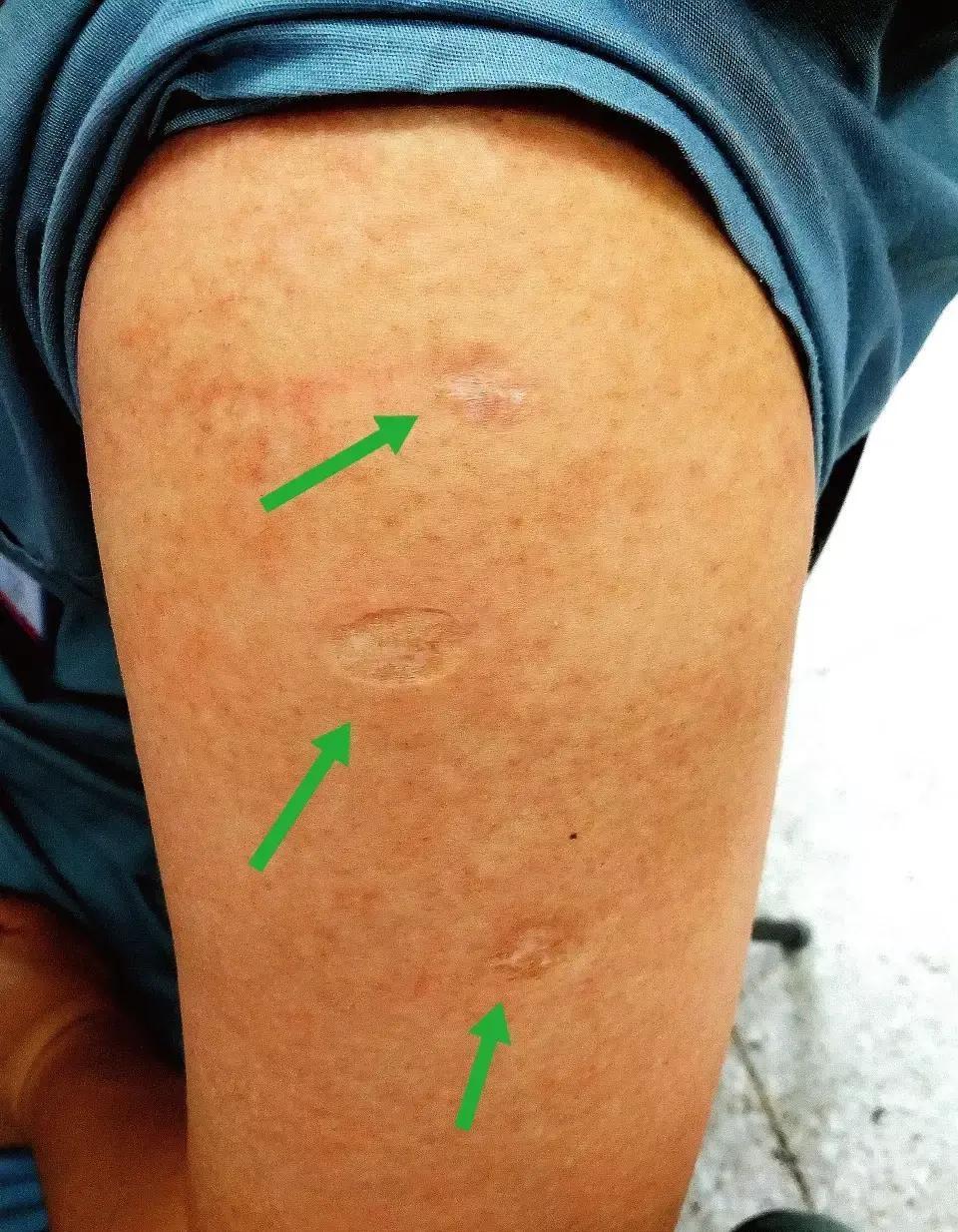 我们人类有两种疫苗是接种在手臂上面的,可能会留下疤痕:第一种是牛痘