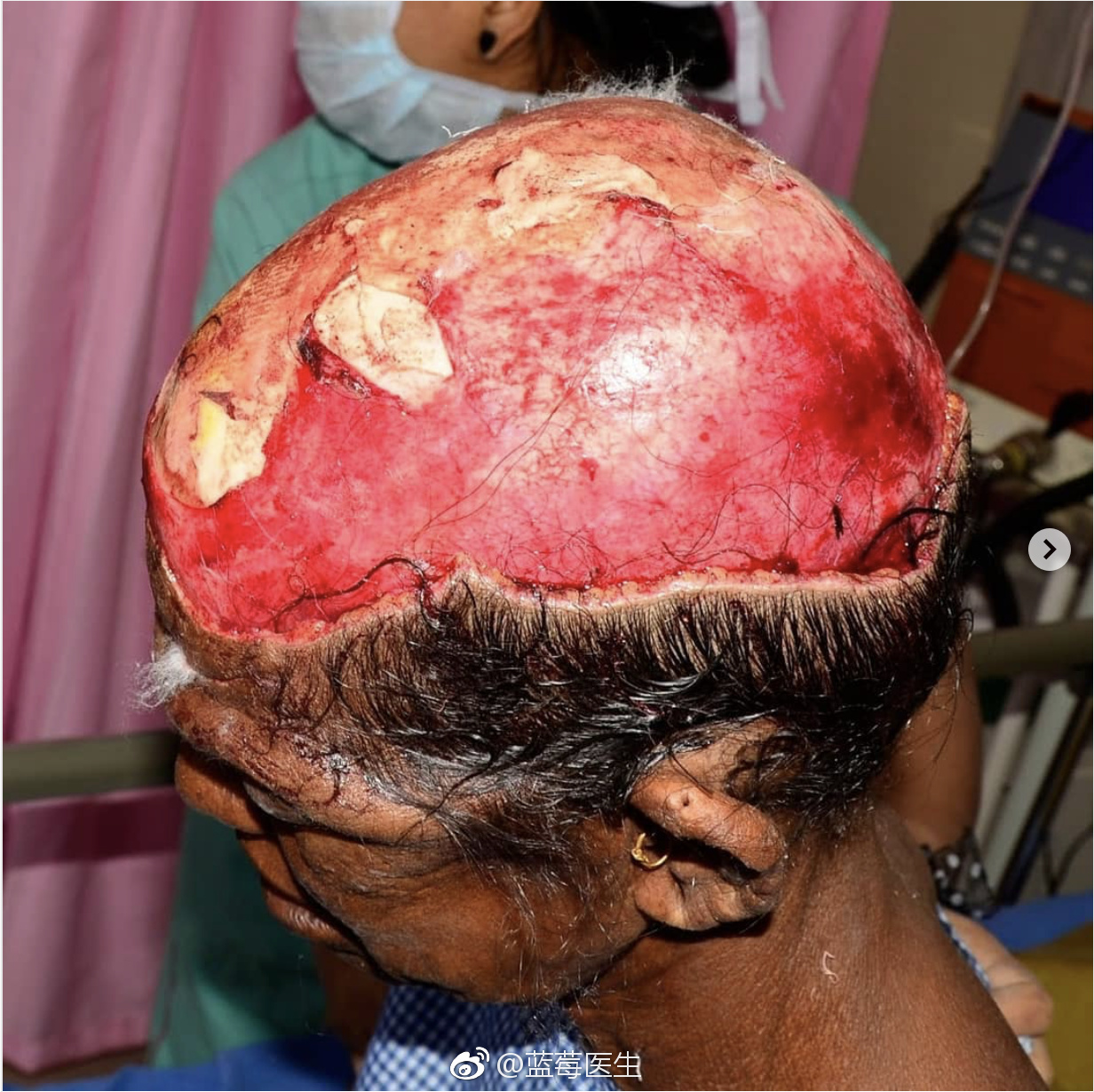 慎点,多保重|颅骨|头皮|医生_新浪新闻