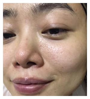 超声刀术后一个月感觉自己年轻了十岁