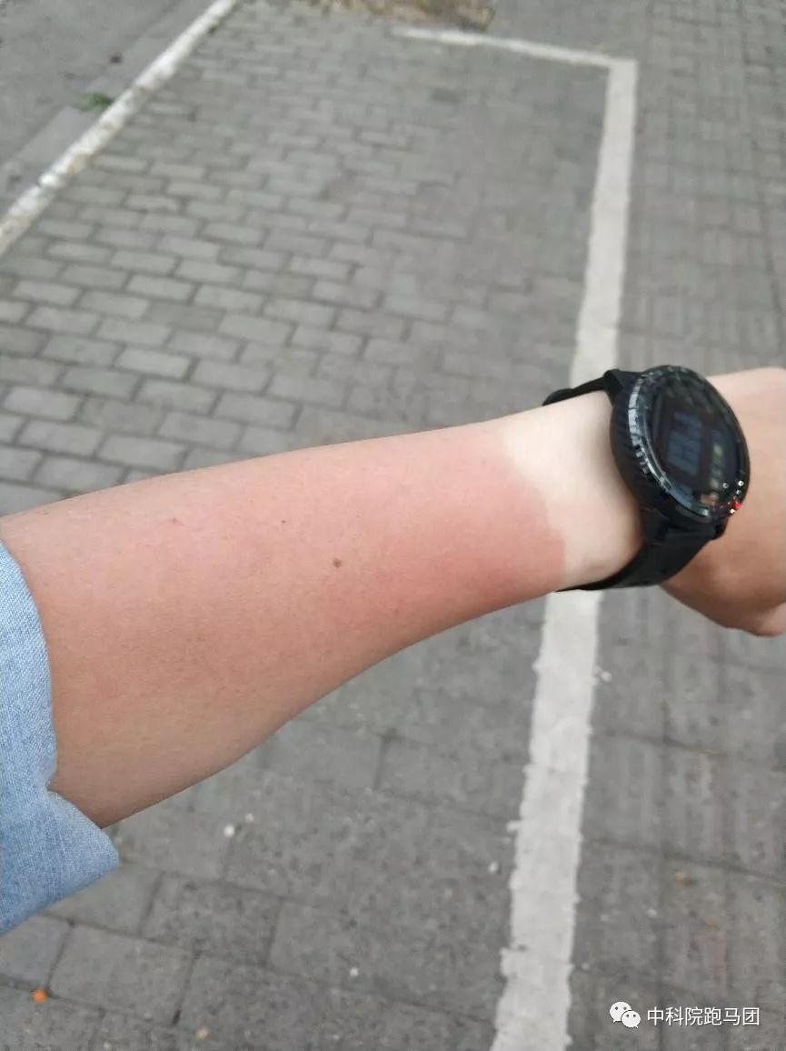 回来后,果然愉快的发现手臂和大腿全部被晒伤.