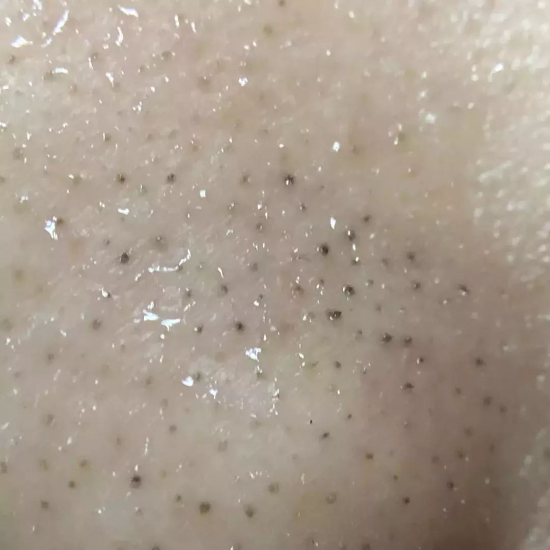 黑头一颗颗被拔出,皮肤秒变奶白豆腐肌