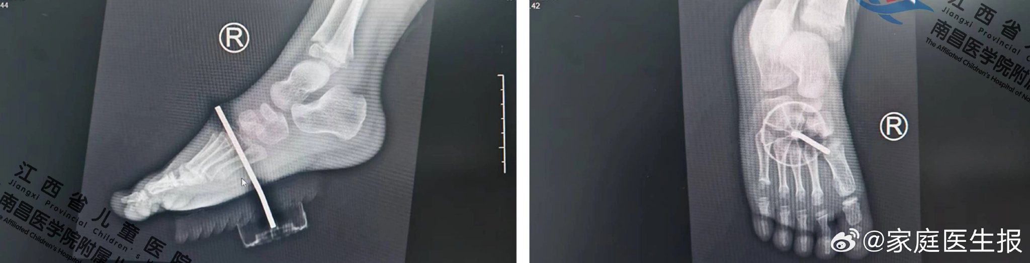 4岁男童足底被5厘米玩具钢钉刺穿，医生紧急手术成功取出